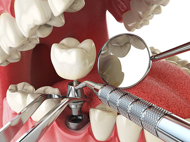 Best Lost Filling or Crown Replacement in Brielle, NJ